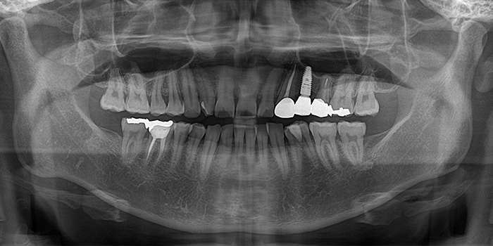 インプラント治療後